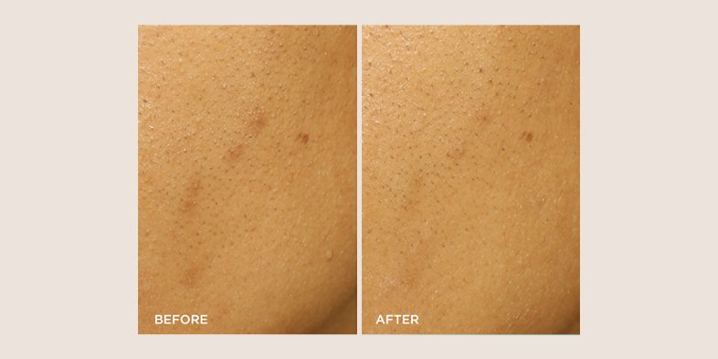 Before and after photo of acne between eyebrows peel